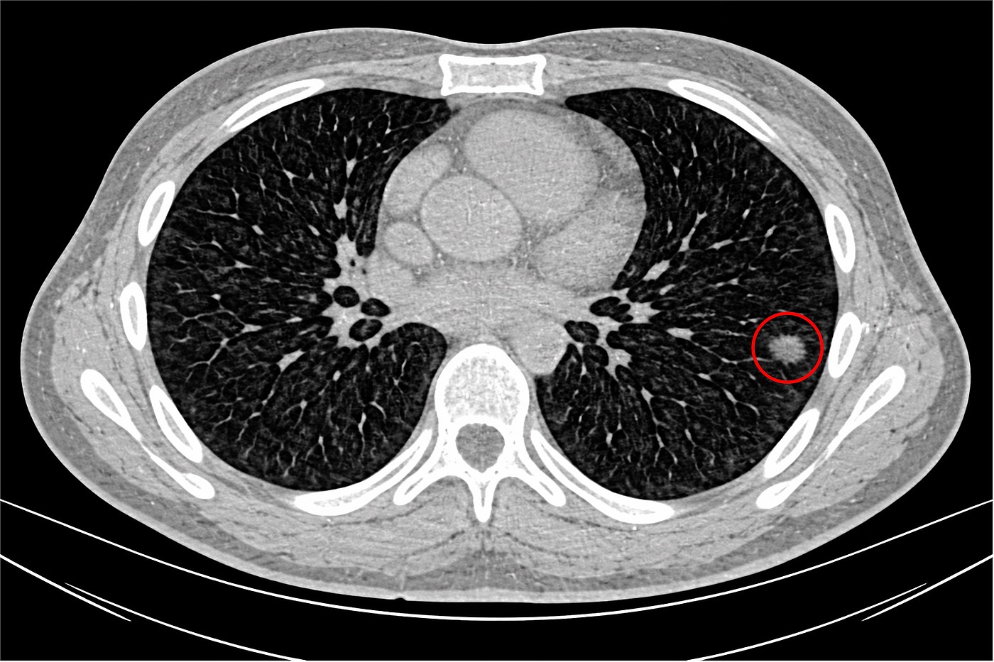 Rundherd. Quelle: Universitätsklinikum Mannheim, V Med. Klinik.