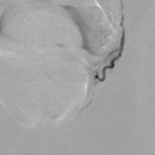 Prostataarterienembolisation