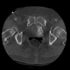 Prostataarterienembolisation
