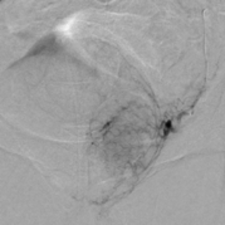 Prostataarterienembolisation