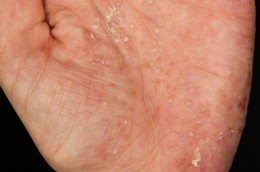 Handinnenfläche mit palmoplantarer Pustulose