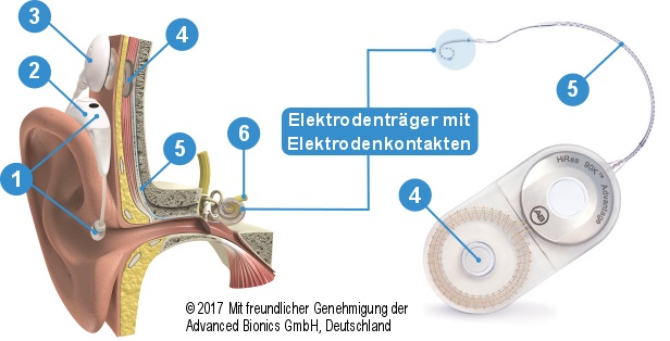 Cochlea Implant Umm Universitatsmedizin Mannheim