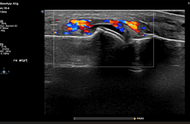 Power-Doppler-Sonographie mit Nachweis entzündlicher Aktivität im Bereich eines Gelenks.   Quelle: Universitätsklinikum Mannheim, V Med. Klinik.Power-Doppler-Sonographie mit Nachweis entzündlicher Aktivität im Bereich eines Gelenks.   Quelle: Universitätsklinikum Mannheim, V Med. Klinik.